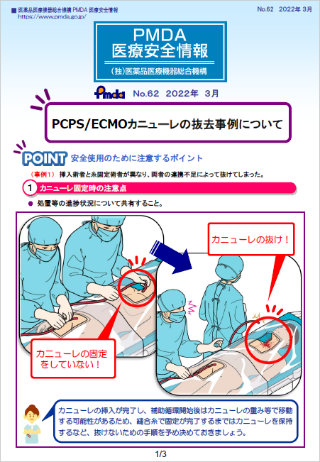 PMDA医療安全情報 No.62 PCPS/ECMOカニューレの抜去事例について　の1枚目のイメージ画像です。クリックするとPDFファイル（883.70KB）が開きます。
